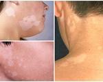 Sự thật về bệnh lang ben qua kính hiển vi và cách phòng ngừa
