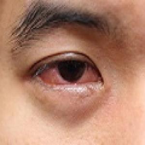 Có những nguyên nhân gì khiến mắt bị đau khi hàn sắt?

